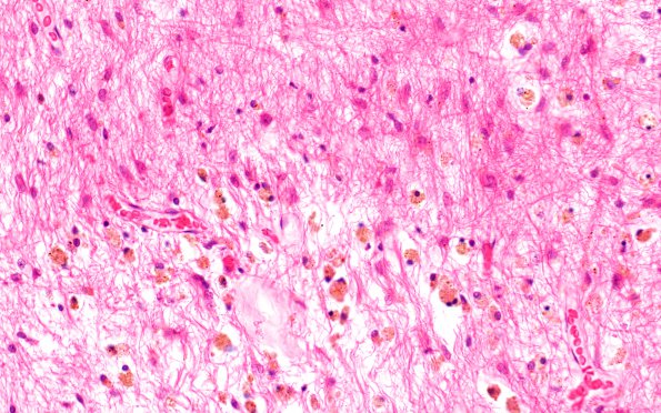 6B3 Porencephaly (Case 6) F H&E WM