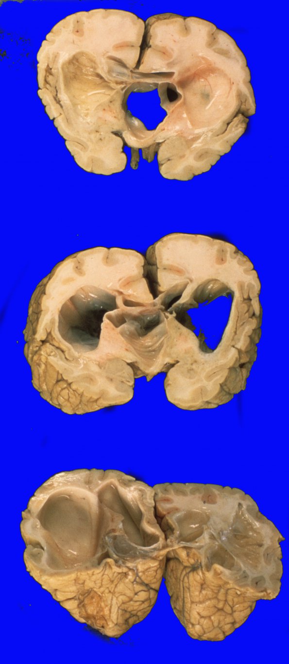 7A1 Porencephaly (Case 7) 2