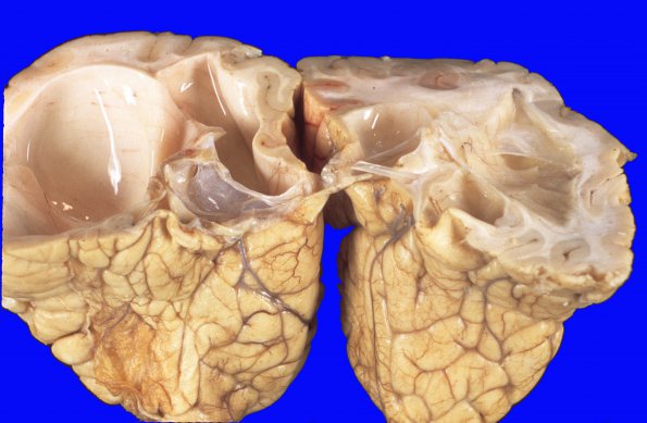 7A3 Porencephaly (Case 7) 3