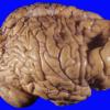 8A1 Porencephaly and hydrocephalus (Case 8) 4