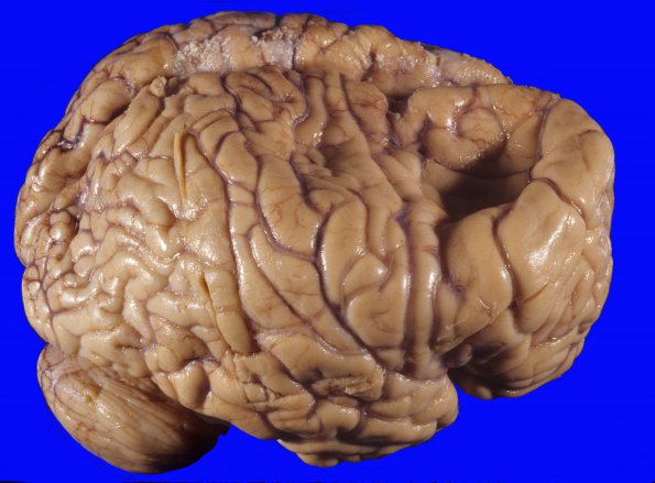 8A1 Porencephaly and hydrocephalus (Case 8) 4