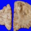 8A2 Porencephaly and hydrocephalus (Case 8) 6