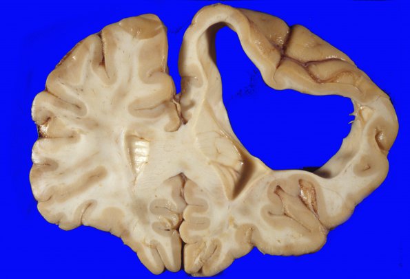 8A3 Porencephaly and hydrocephalus (Case 8) 2