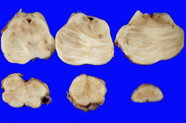 8A4 Porencephaly and hydrocephalus (Case 8) 3