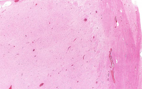 1B1 Hypoxia Ischemia, neonatal (Case 1) 2 2X 4