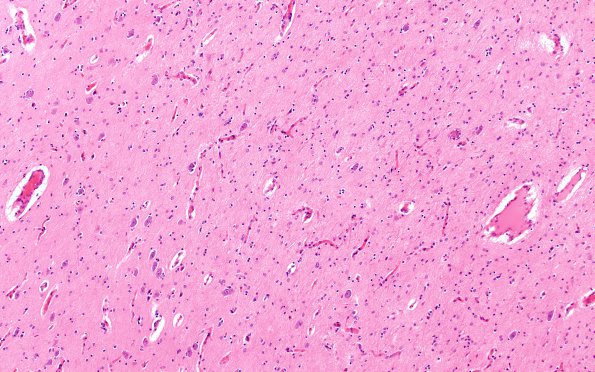 1B3 Hypoxia Ischemia, neonatal (Case 1) 2 10X 2