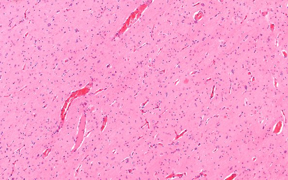 1B4 Hypoxia Ischemia, neonatal (Case 1) 2 20X 3