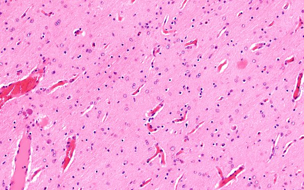 1B5 Hypoxia Ischemia, neonatal (Case 1) 2 20X 4