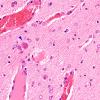 1B6 Hypoxia Ischemia, neonatal (Case 1) 2 40X 2 copy