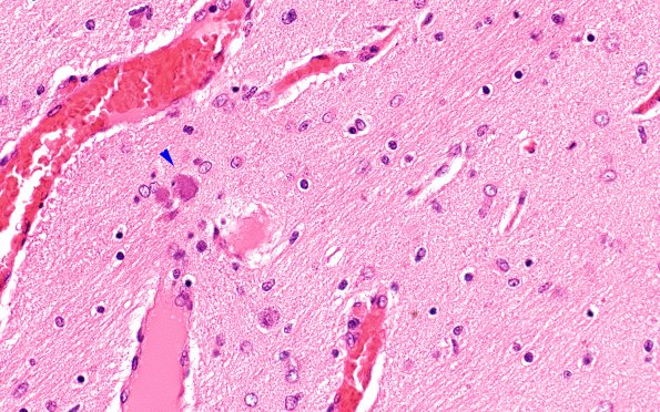 1B6 Hypoxia Ischemia, neonatal (Case 1) 2 40X 2 copy