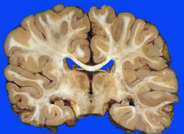 2A1 H-I, neonatal Stat Marmoratus (Case 2) b