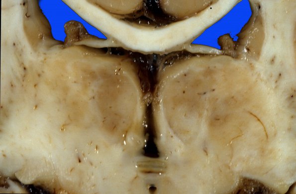 2A2 H-I, neonatal Stat Marmoratus (Case 2) a