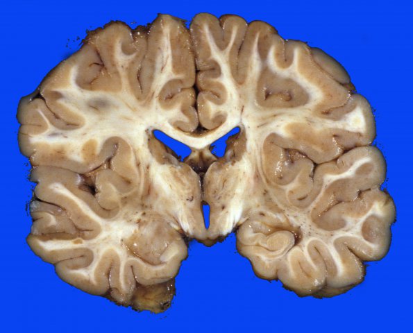 2A3 H-I, neonatal Stat Marmoratus (Case 2) c