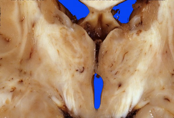 2A4 H-I, neonatal Stat Marmoratus (Case 2) d