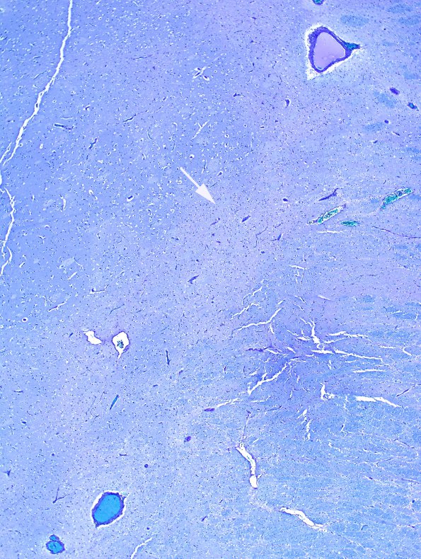 2C4 H-I, neonatal Stat Marmoratus (Case 2) 2 LFB-PAS copy