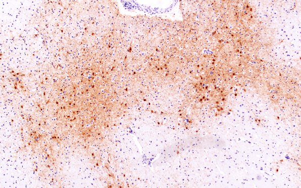 2C5 (Case 2) N2 GFAP 10X comparison 2B