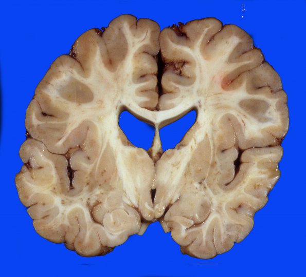 3A1 H-I, 25 wk, lived 3 yr, st marmoratus, (Case 3) 9