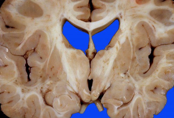 3A2 H-I, 25 wk, lived 3 yr, st marmoratus, (Case 3) 1