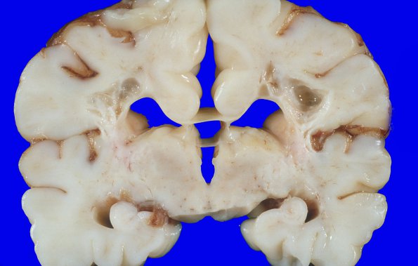 4A1 Hypxia-Ischemia, fetal neonatal (Case 4) N21 Gross