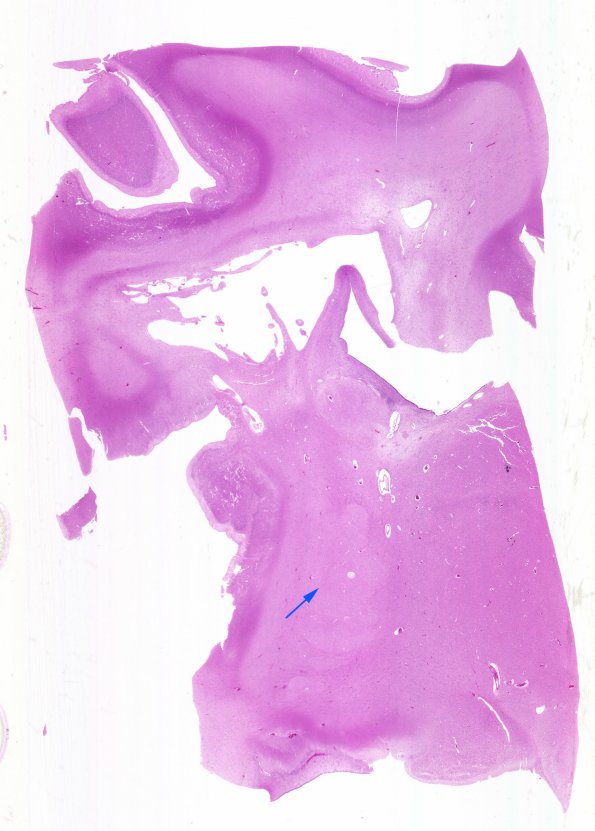 4B1 Hypxia-Ischemia, fetal neonatal (Case 4) N21 H&E WM copy