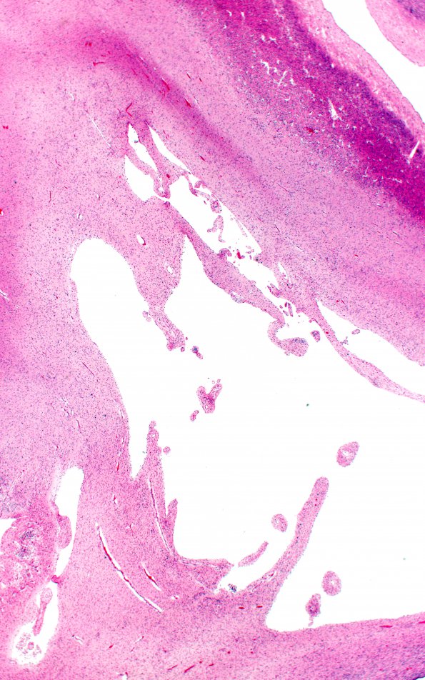 4B2 Hypxia-Ischemia, fetal neonatal (Case 4) N2 H&E 2X