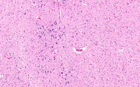 4B3 Hypxia-Ischemia, fetal neonatal (Case 4) N2 H&E 2