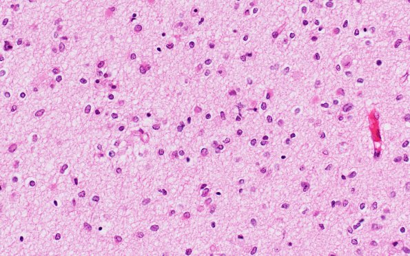 4B4 Hypxia-Ischemia, fetal neonatal (Case 4) N2 H&E 40X