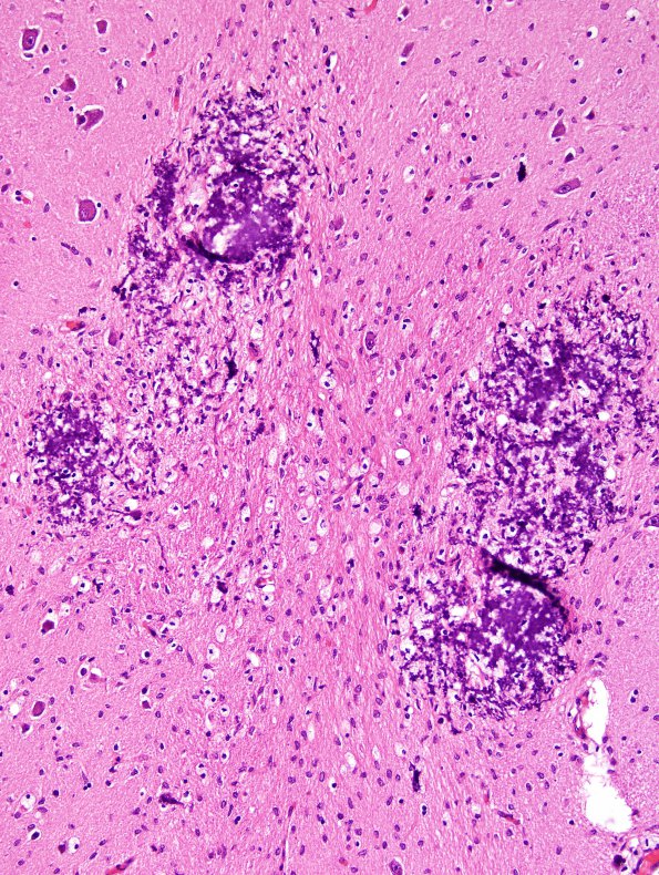 5A3 Hypoxia-Ischemia, neonatal (Case 5) N4 H&E 2