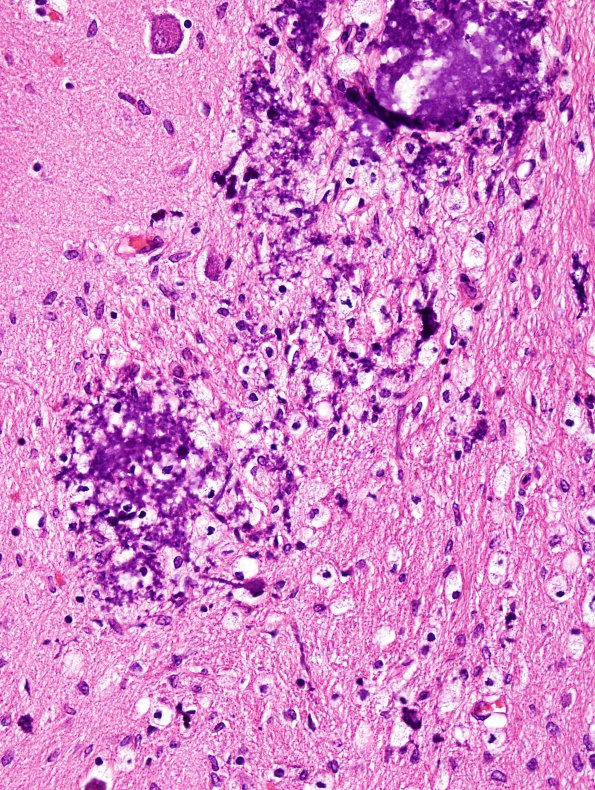 Filename: 5A4 Hypoxia-Ischemia, neonatal (Case 5) N4 H&E 1 - Copy