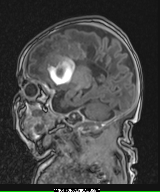 10A1 H-I, HLH, neonatal 34wk & 6wk (Case 10) T1 MPRAGE - Copy