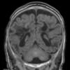 10A2 H-I, HLH, neonatal 34wk & 6wk (Case 10) T1 3 - Copy