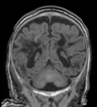 10A2 H-I, HLH, neonatal 34wk & 6wk (Case 10) T1 3 - Copy