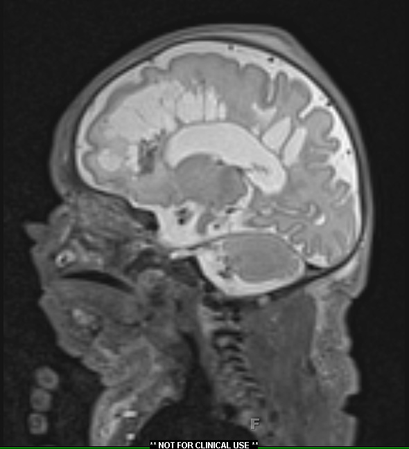 10A3 H-I, HLH, neonatal 34wk & 6wk (Case 10) T2 - Copy