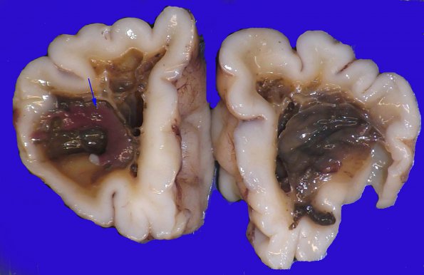 10B1 H-I, HLH, neonatal 34wk & 6wk (Case 10) 1 copy