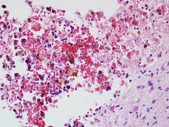 10B2 H-I, HLH, neonatal 34wk & 6wk (Case 10) N2 H&E 3