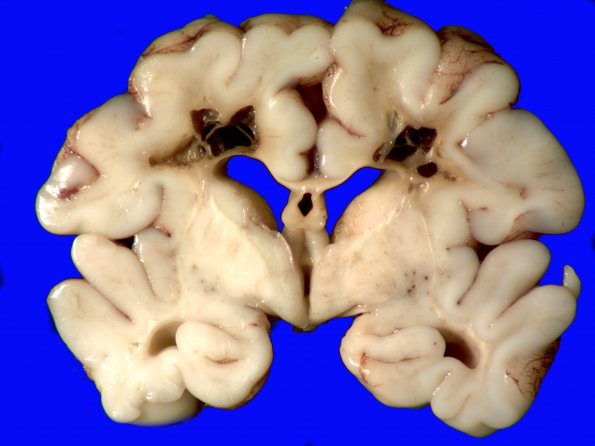 10C1 H-I, HLH, neonatal 34wk & 6wk (Case 10) A_4