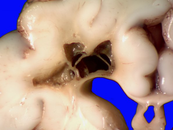 10C2 H-I, HLH, neonatal 34wk & 6wk (Case 10) A_5