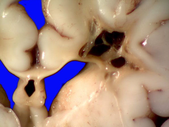 10C3 H-I, HLH, neonatal 34wk & 6wk (Case 10) A_6