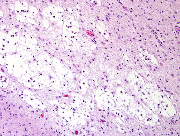 10D2 H-I, HLH, neonatal 34wk & 6wk (Case 10) H&E 2