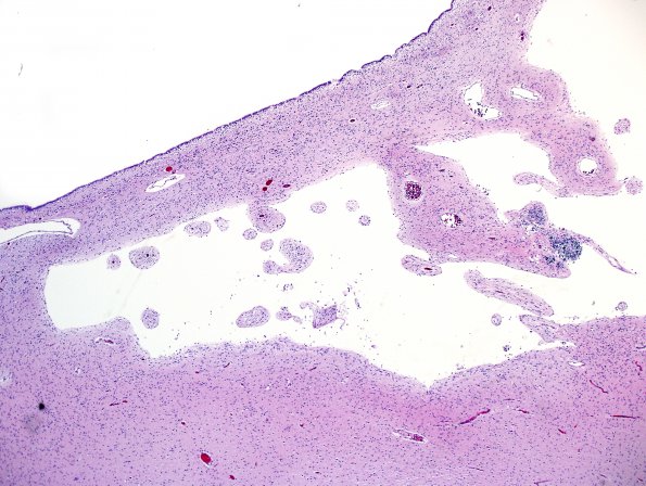 10D3 H-I, HLH, neonatal 34wk & 6wk (Case 10) N3 H&E 4.jpg