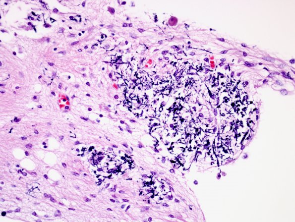 10D4 H-I, HLH, neonatal 34wk & 6wk (Case 10) N3 H&E 1.jpg