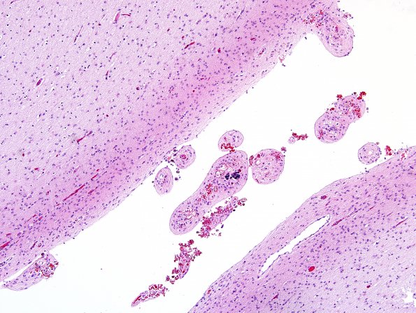 10D5 H-I, HLH, neonatal 34wk & 6wk (Case 10) H&E 3.jpg