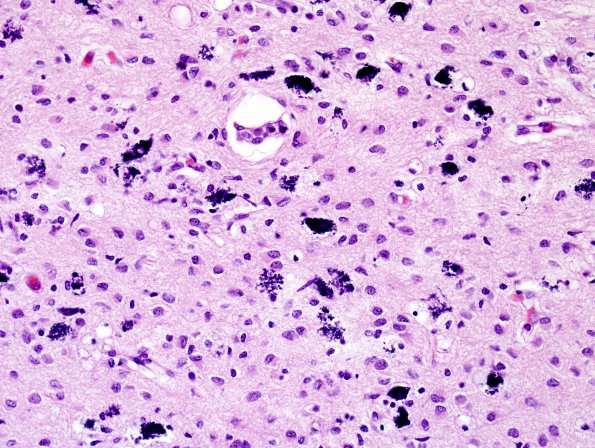 10D7 H-I, HLH, neonatal 34wk & 6wk (Case 10) N5 H&E 5.jpg