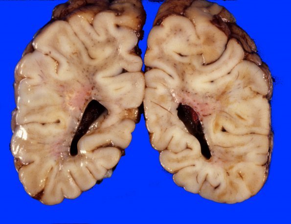 11A1 Hypoxia-Ischemia, neonatal, (Case 11) 1