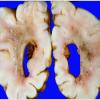 11A2 Hypoxia-Ischemia, neonatal, (Case 11) PVL 1