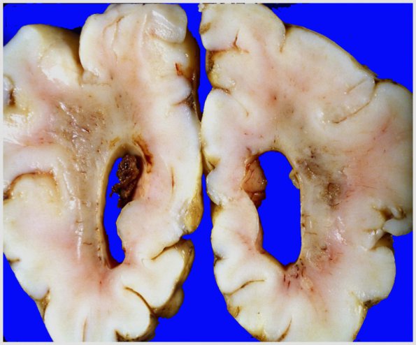 11A2 Hypoxia-Ischemia, neonatal, (Case 11) PVL 1