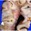 11A3 Hypoxia-Ischemia, neonatal, (Case 11) 3