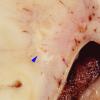 11A4 Hypoxia-Ischemia, neonatal, (Case 11) 2 copy