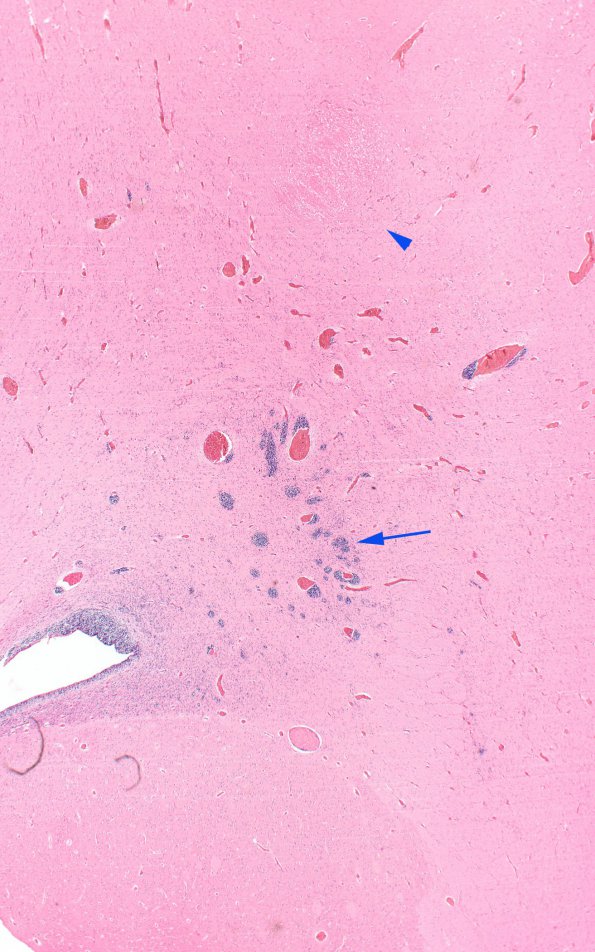 11B2 Hypoxia-Ischemia, neonatal, (Case 11) H&E 2X