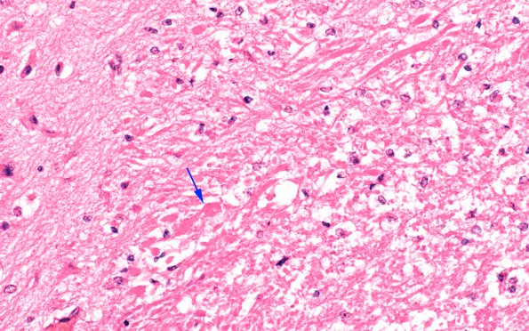 11B4 Hypoxia-Ischemia, neonatal, (Case 11) H&E 40X copy